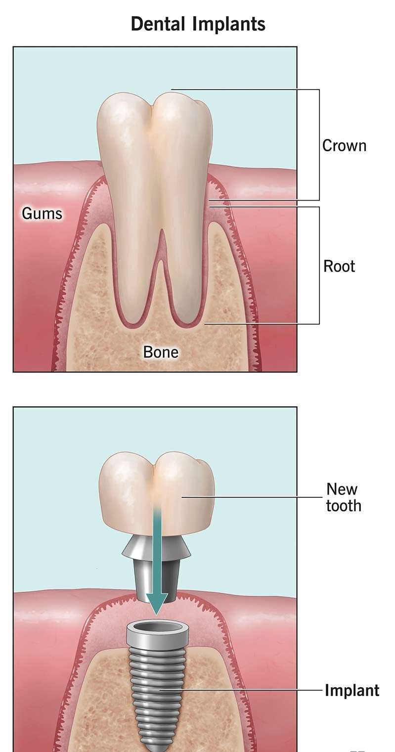 https://dentturkey.net/wp-content/uploads/2024/08/10903-dental-implants-e1722787037202.jpg