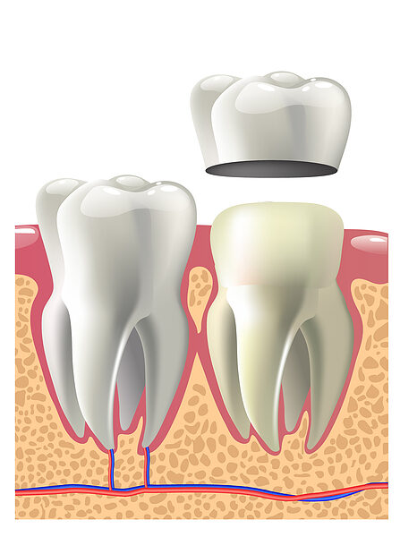 Dental crown installation process. Dental care concept.